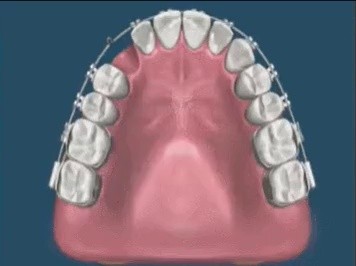 歯移動シミュレーション