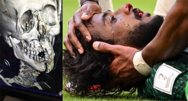 アルゼンチン戦で負傷したサウジ選手は顔面完全骨折ですね。