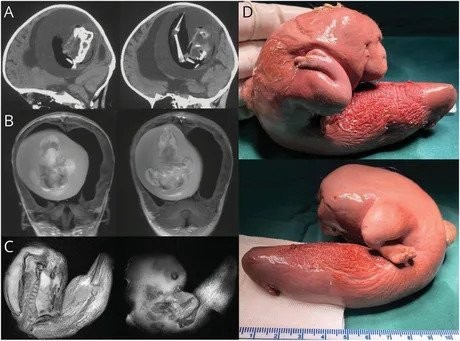 嫌悪1歳の女児の脳から双子が育つ