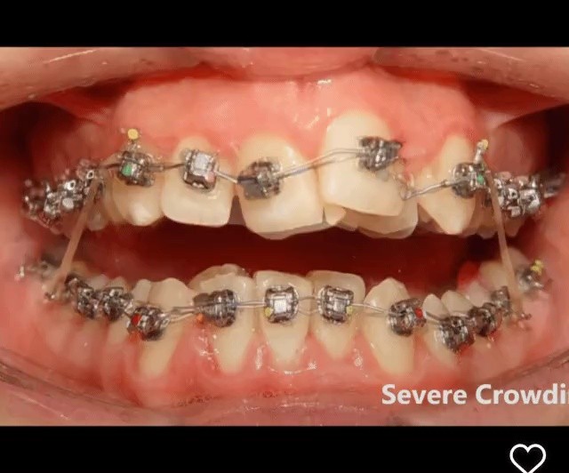 歯の矯正で配列が整う様子