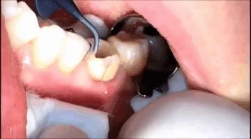薬嫌い 歯ぐきの膿除去gif