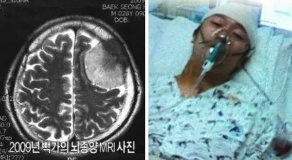 コヨーテペッカ脳腫瘍当時のMRI写真