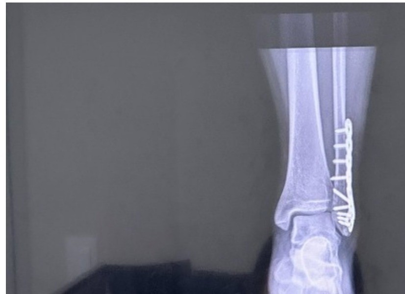足首が折れたのに全く痛くないという女性の11ヵ月後の近況