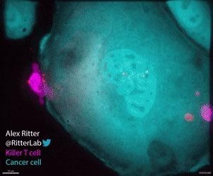 免疫T細胞が卵巣癌を一気に破壊する様子