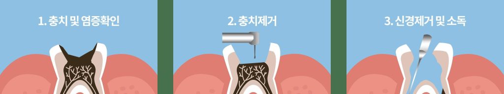 (SOUND)歯科神経治療の原理