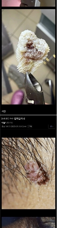 極度に憎たらしい）有名なトウモロコシのいぼギャラリー