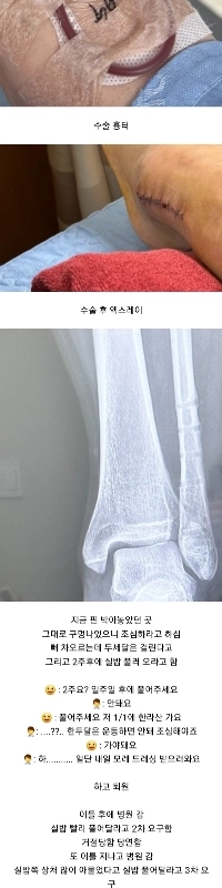 足首を骨折したが11ヵ月経っても全く痛くなかったという女性ㄷㄷ