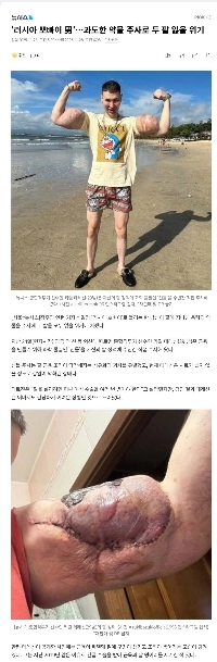 「ロシアのポパイ男」…過剰な薬物注射で両腕を失う危険も