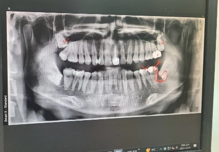 親知らずを4本全部抜かないといけないのですが、大変です。 （写真）