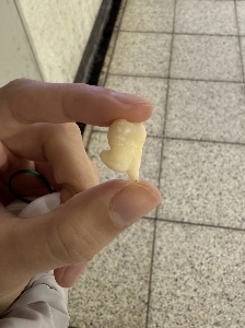 モデルの親知らずが日本で話題に