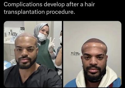 髪の毛をよく調べずに無謀に植毛した男の末路