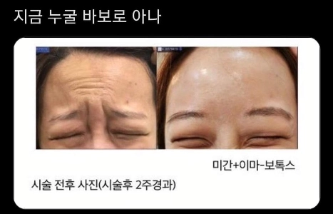 効果が明らかなボトックス治療前後の写真ㄷㄷㄷ.JPG