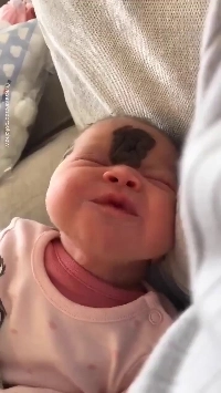 (SOUND)顔に大きなほくろを持って生まれた赤ちゃん.gif