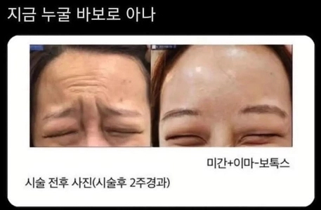 効果が明らかなボトックス治療前後の写真ㄷㄷㄷ.JPG