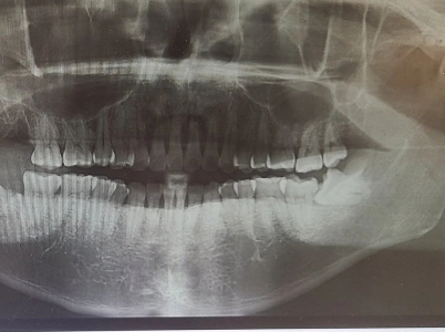 埋伏した親知らずの抜歯はどれくらい難しいですか？