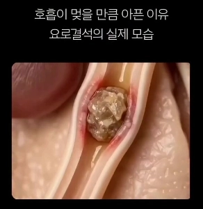 (SOUND)【医学】尿路結石はなぜ痛いのか