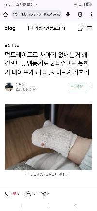 民間療法で足底疣贅を取り除く方法