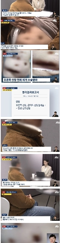 腎臓が癌だったので摘出したのですが、癌ではありませんでした。