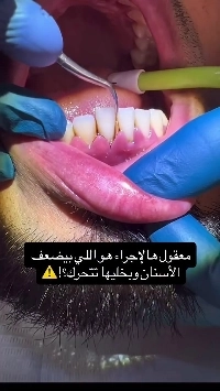 (SOUND)注意：固まった歯石の除去